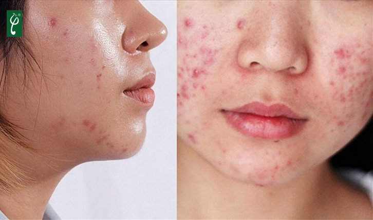 Sữa rửa mặt tràm trà